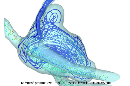 aneurysm
